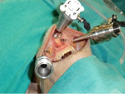 Robotic Thyroid Surgeon in India