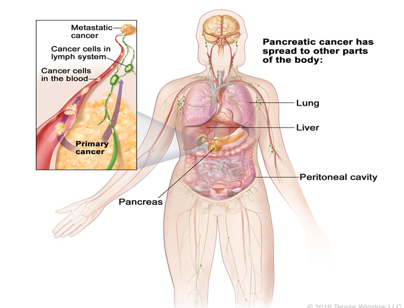 Pancreatic Cancer treatment in Pune
