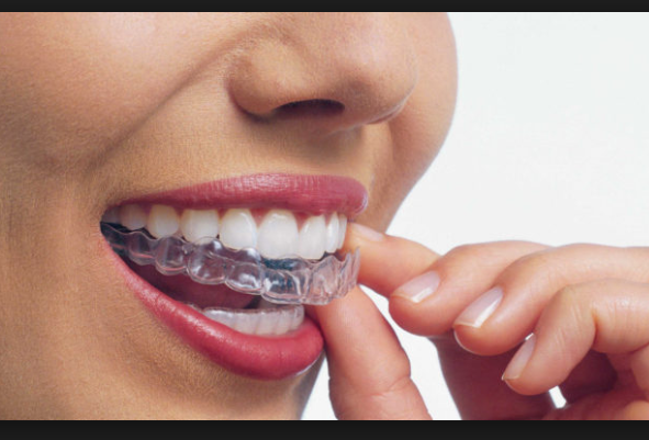 Invisalign Essendon - Dentist Essendon | Invisalign