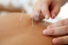 Best Effectiveness Acupuncture Services in Gaithersburg MD