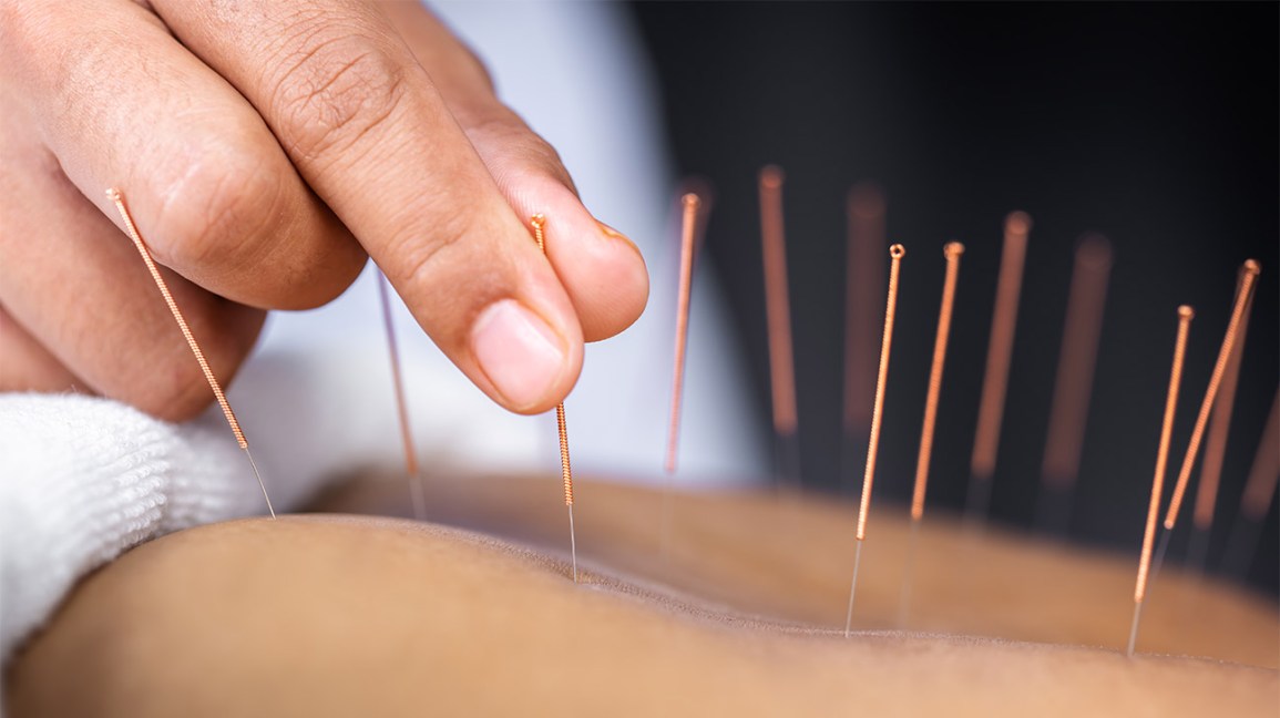 Find the Best Acupuncture in Gaithersburg Maryland