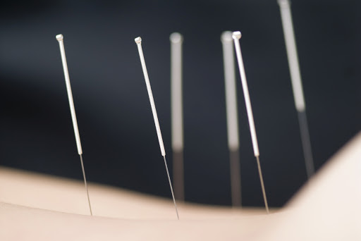 Best Facial Acupuncture In Gaithersburg Md - KOSA Acupuncture