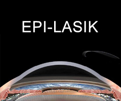 Lasik Eye Surgery Cost in UAE