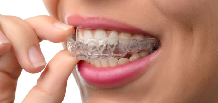 How Long Does Invisalign Take