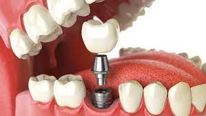 Dental Implants in Birmingham, AL - How They Work