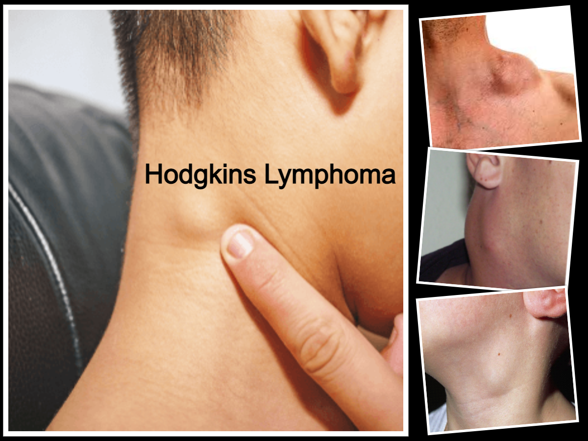 Hodgkins Lymphoma Treatment Medication List