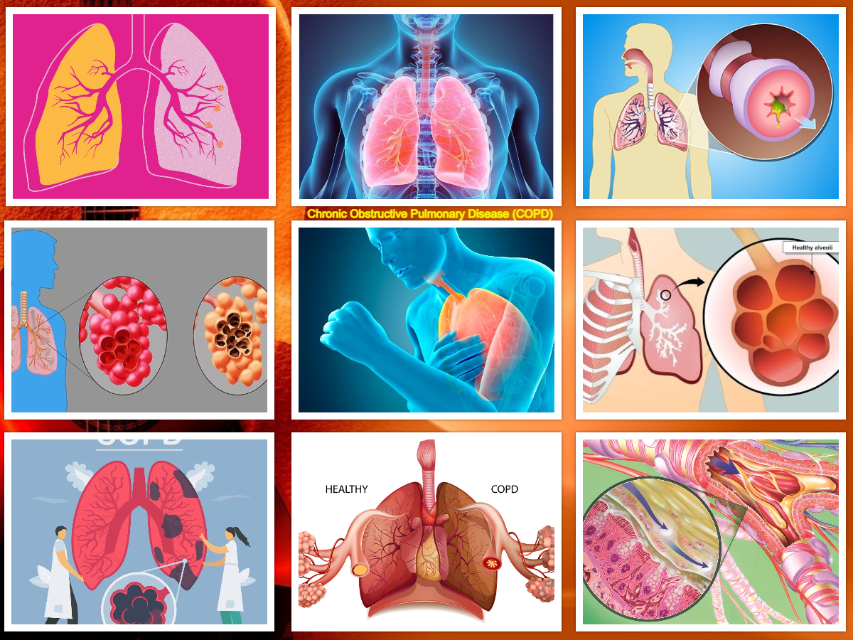 Chronic Obstructive Pulmonary Disease (COPD) Treatment Medication