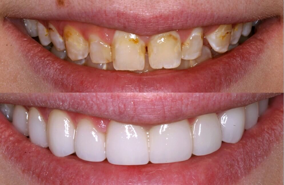Porcelain Veneers Treatment in Prosper TX