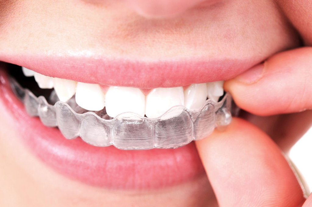 Boss Clear Aligner Therapy in Prosper TX
