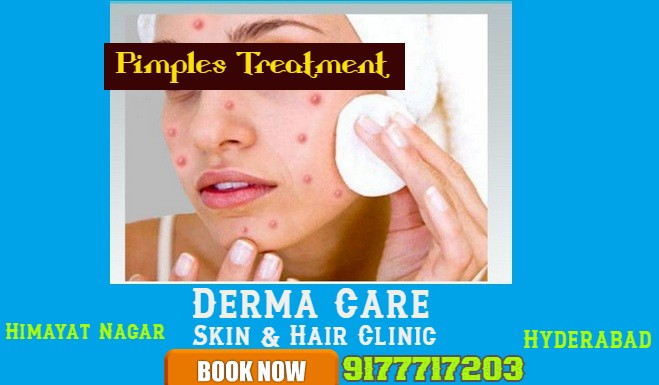 How We Can Decrease Our Pimples?