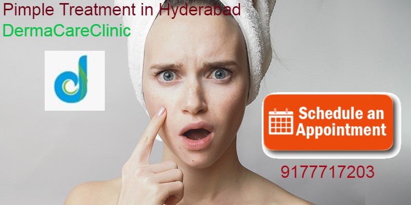 5 Simple Methods to Get Rid of Pimples