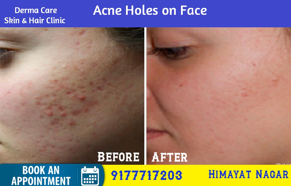 How to Remove Acne Holes On Face