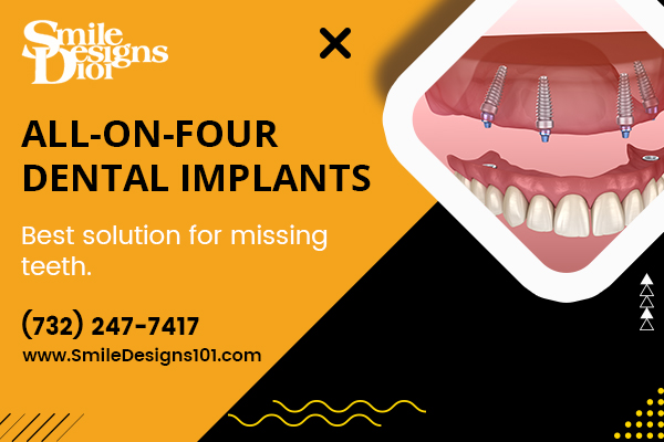 What are the main benefits of all-on-4 dental implants?