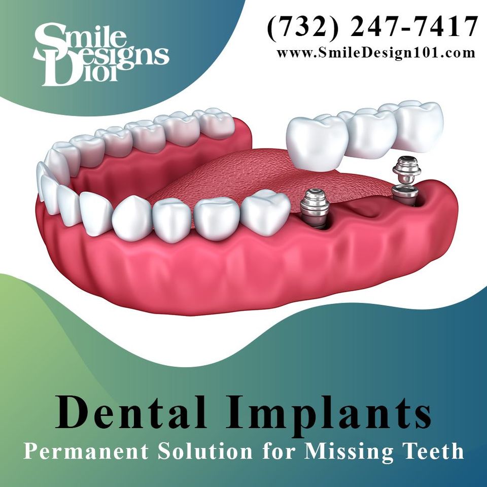 Full Dental Implant Treatment, NJ