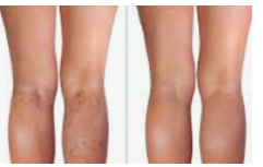 Varicose Vein Treatments