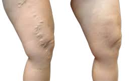 Best Vein Center