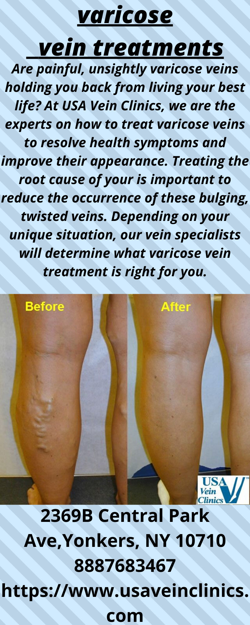 varicose vein treatments