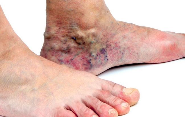 Spider Vein Removal Treatment