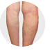 Spider Vein Removal Treatment