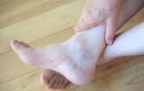 varicose veins treatment miami