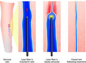 Surgical Treatment for Varicose Veins