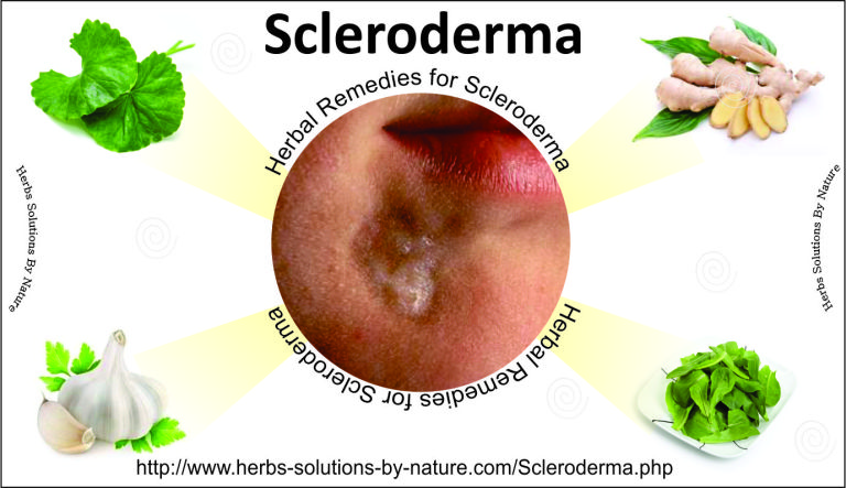 5 Effectively Herbal Remedies for Scleroderma