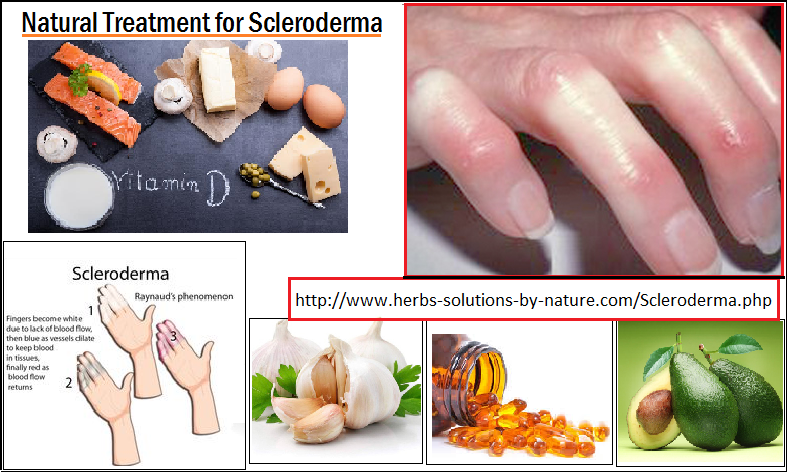 Herbal Remedies for Scleroderma Cope the Symptoms