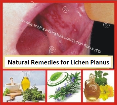 Natural Remedies for Lichen Planus Treat the Itchy Skin Rash