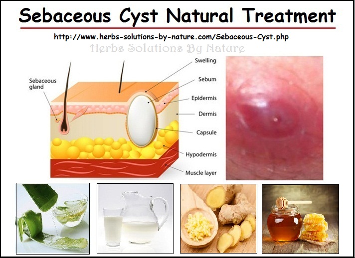 Natural Remedies for Sebaceous Cyst Diet Tips and Prevention