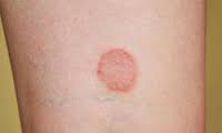 Lichen Planus – A Skin Condition