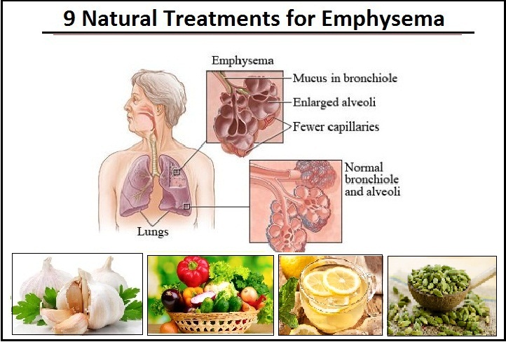 Natural Remedies for Emphysema can Improve Life Expectancy