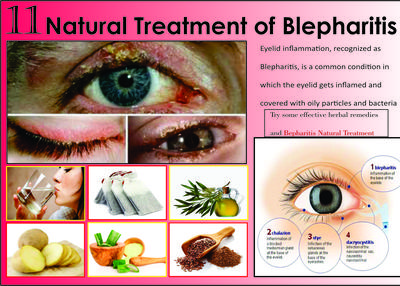 11 Best Natural Treatments of Blepharitis