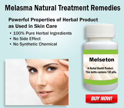 Melasma Natural Treatment Remedies, Symptoms, Causes and Diagnosis