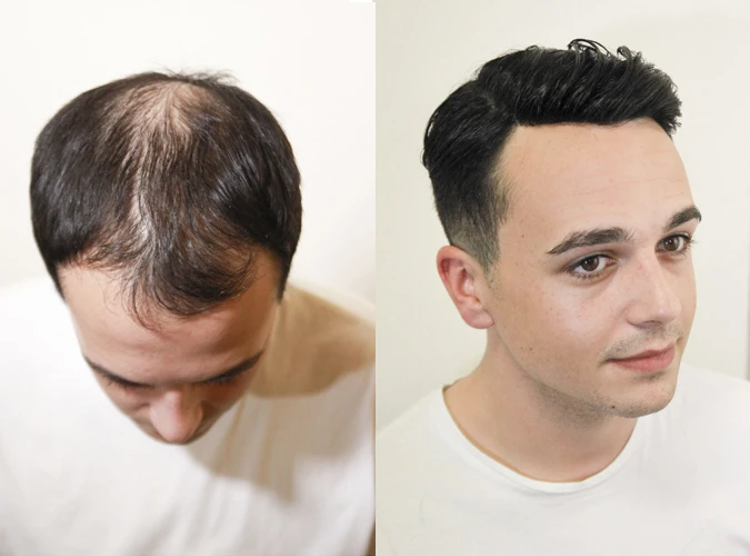 Benefits of buying a heat resistant synthetic mens toupee