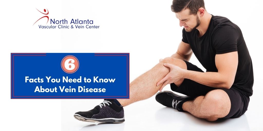 Facts You Need to Know About Vein Disease
