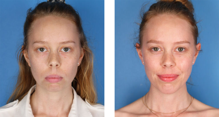 chin augmentation