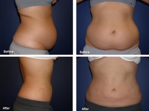 Best  Liposuction Surgery