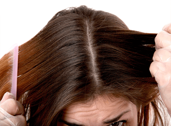 Natural Remedies for Dandruff