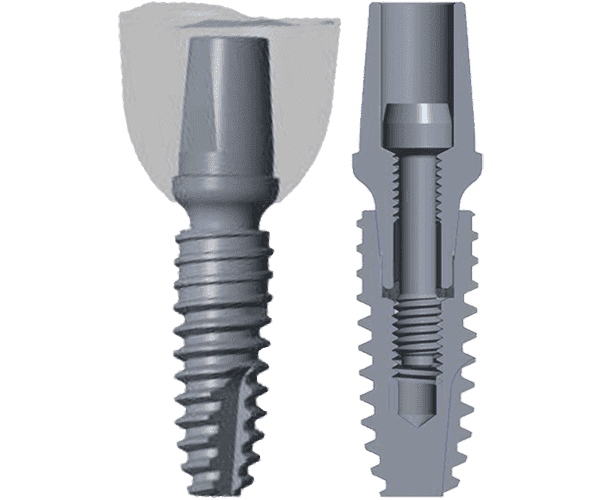 Best Dental Implants In India