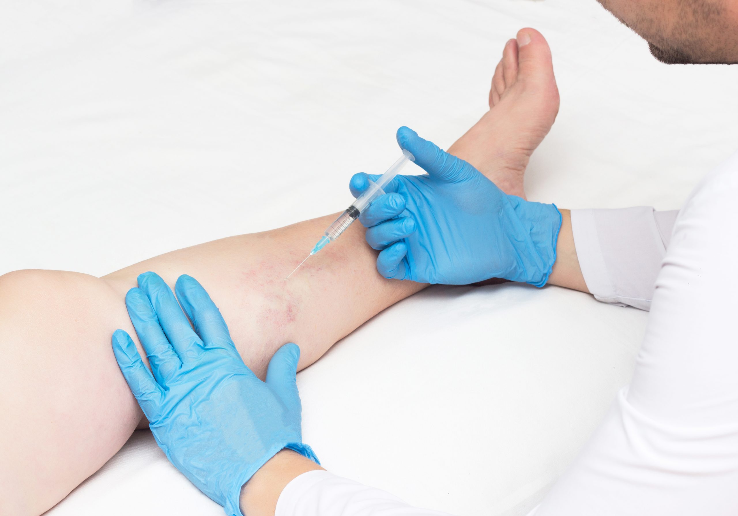 Three Most Recommended Spider Vein Removal Methods: