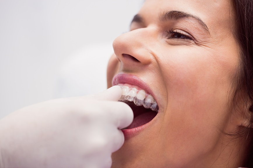 6 Questions You Need to Know Before Getting Invisalign.