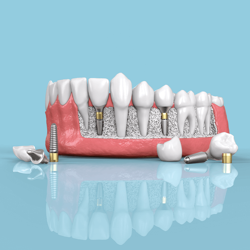 Understanding Dental Implants: What they are, why you should use them, and who should talk to for treatment.