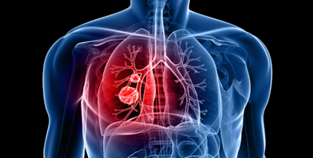 Best Pulmonology Hospital in Hadapsar Pune