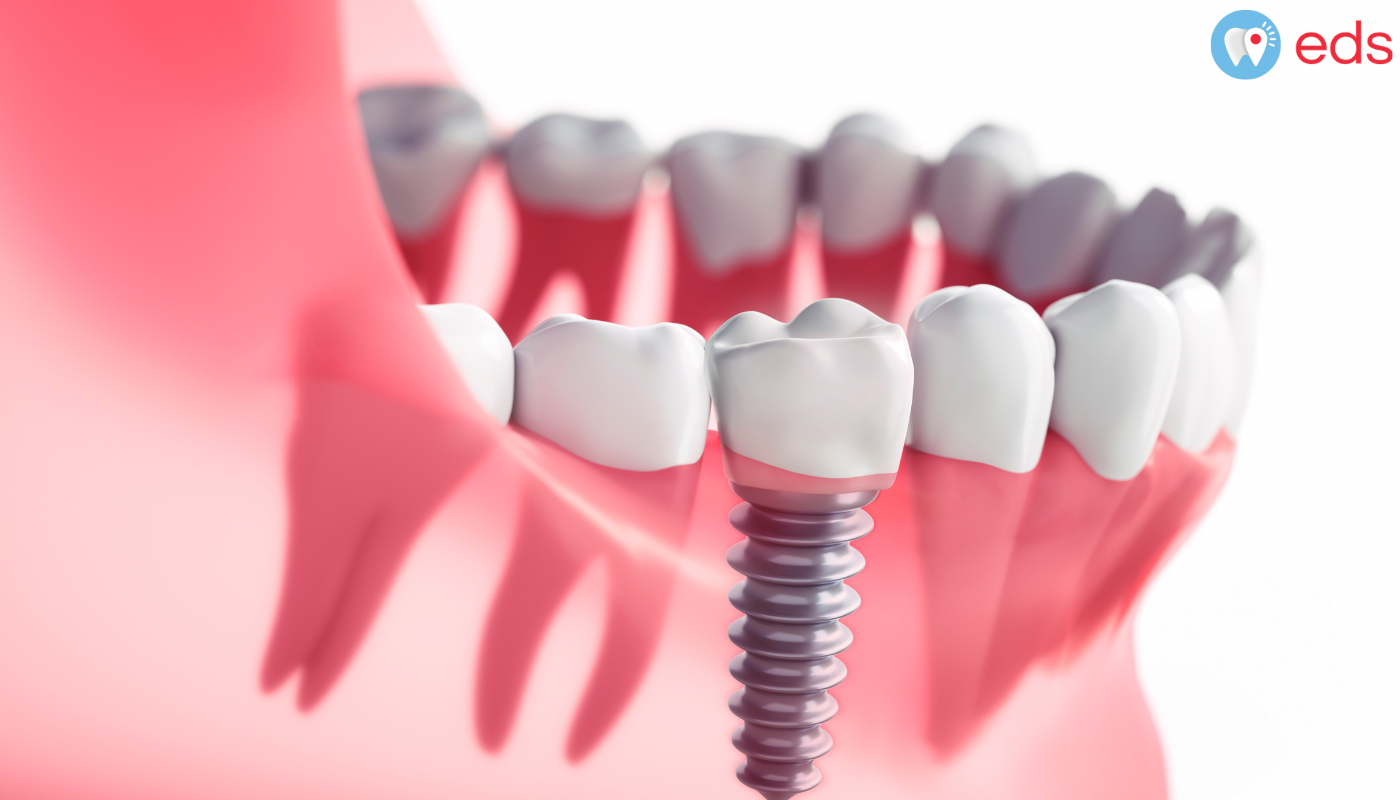 What are the Benefits and Procedures for Mini Dental Implants?
