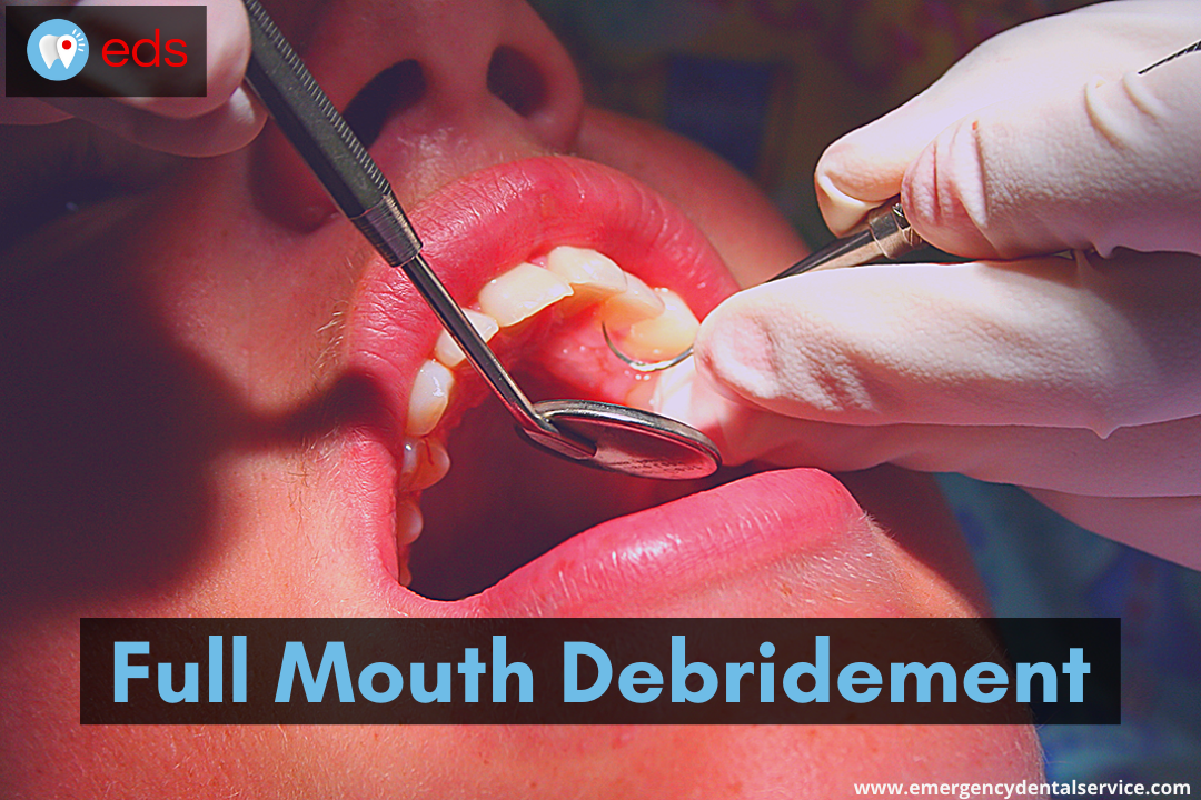 HOW MUCH TIME A FULL MOUTH DEBRIDEMENT TAKE?