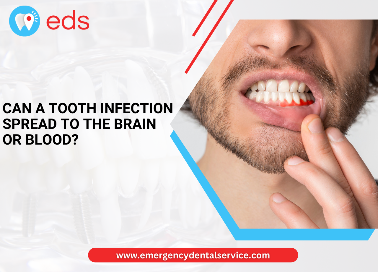 Can a Tooth Infection Spread to the Brain or Blood?