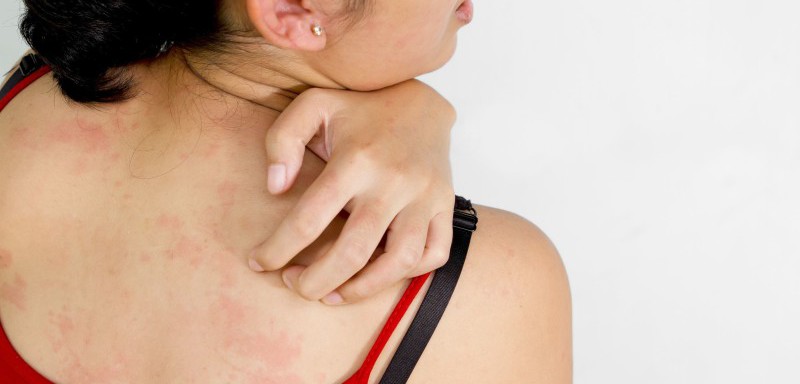 Best Psoriasis Treatment Clinic in Sector 51 Gurgaon