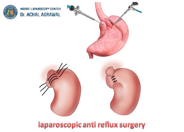 Laparoscopic Anti Reflux Surgery at Indore-Laparoscopy-Center