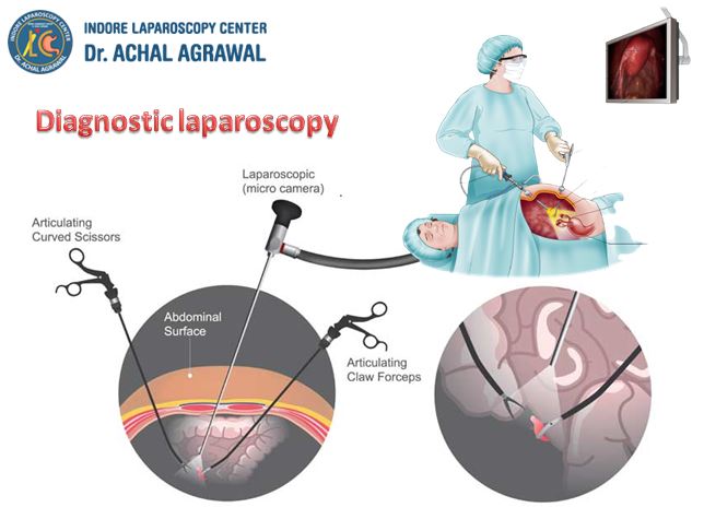 Diagnostic Laparoscopy by Dr. Achal Agarwal. Call: +91-9171770805