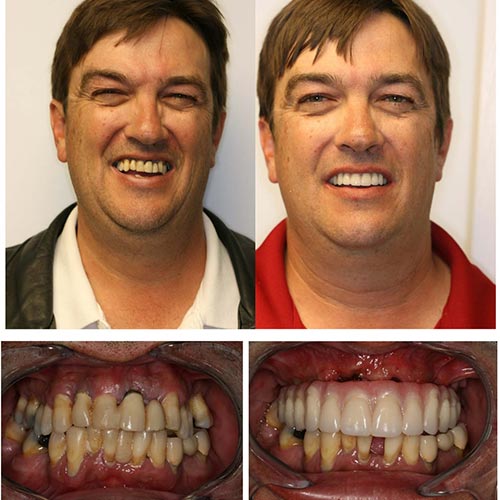 All On Four İmplant